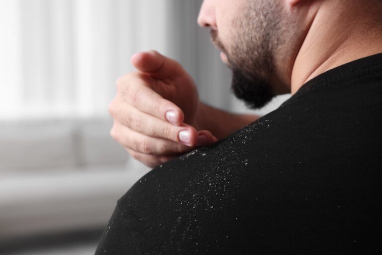 Person brushing off dandruff from shoulder.